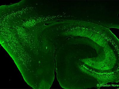 Image of neurodegeneration